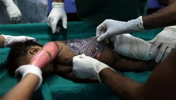 Brazil: Dùng da cá rô phi để điều trị bỏng