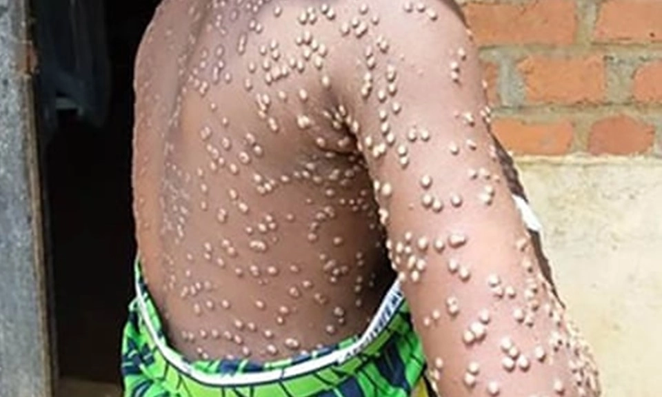 Congo: Cảnh báo chủng đậu mùa khỉ nguy hiểm khiến nhiều trẻ em tử vong