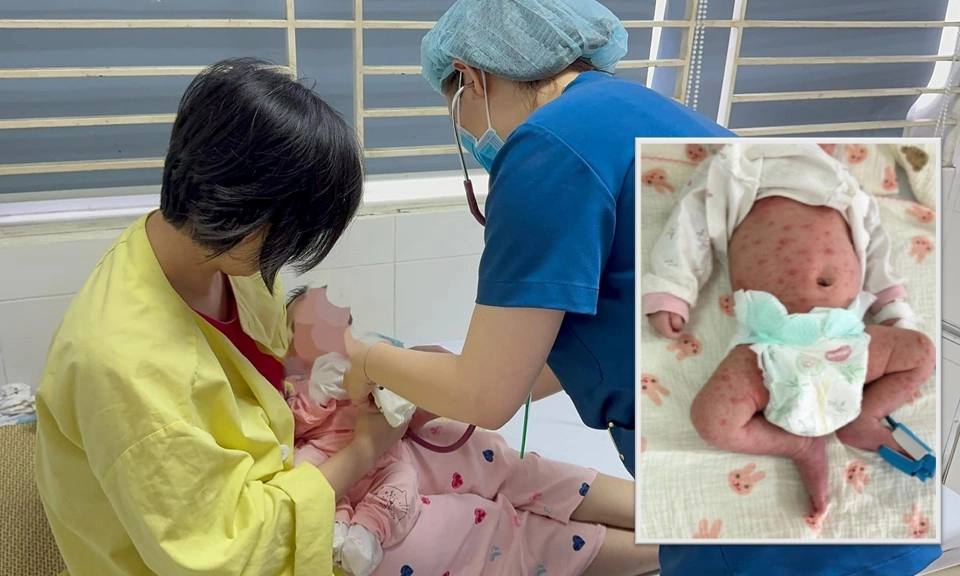 Hai trẻ sơ sinh lây bệnh thủy đậu từ mẹ