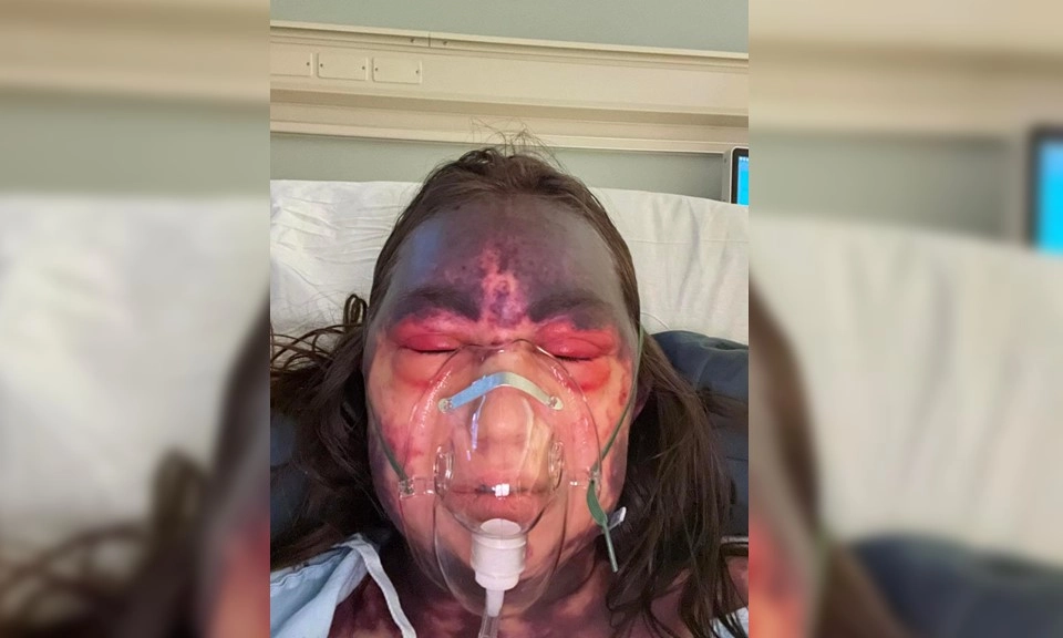 Một người phụ nữ bị mù và bầm tím toàn thân sau khi tiêm 3 loại vaccine cùng lúc