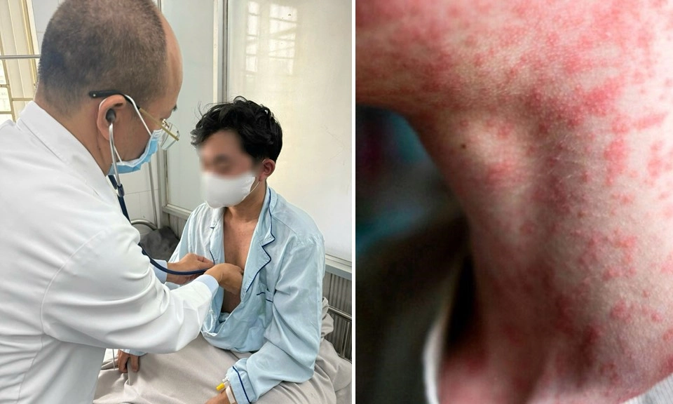 Cảnh báo gia tăng ca bệnh sởi ở người lớn
