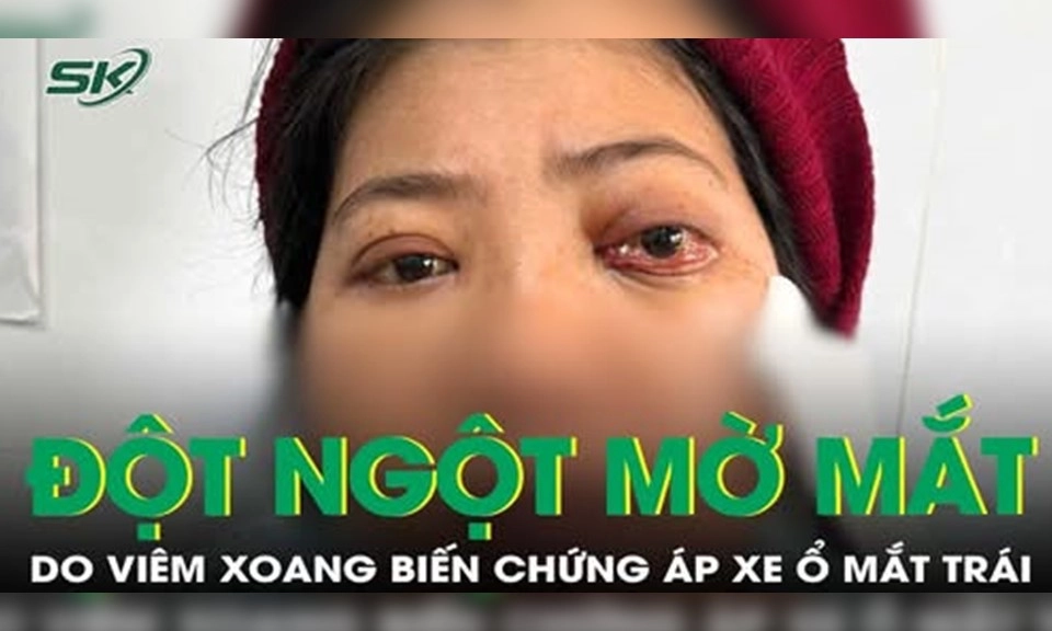 Mờ mắt đột ngột do viêm xoang biến chứng