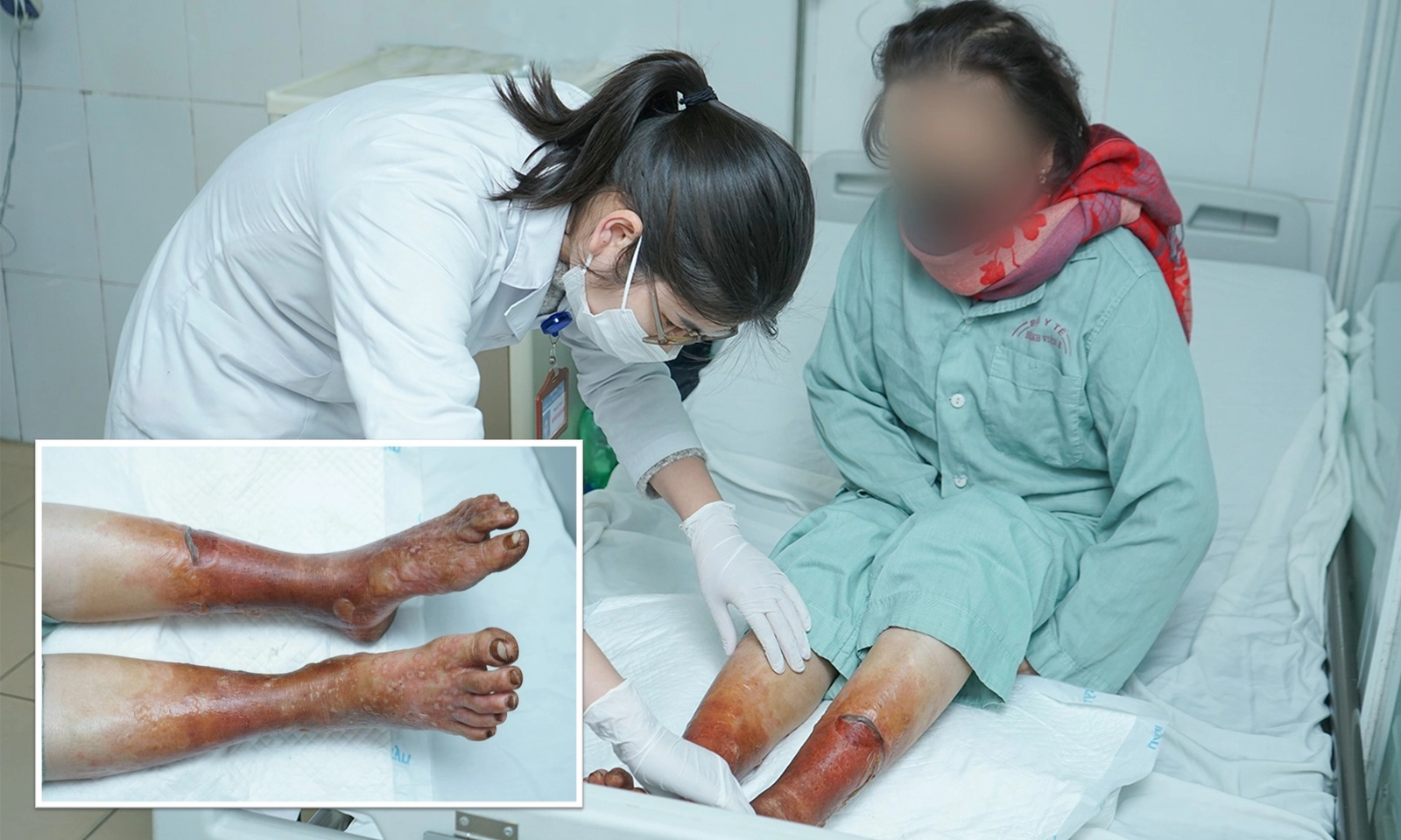 Hoại tử cả hai bàn chân vì ngâm chân giữ ấm bằng loại bột lá không rõ nguồn gốc