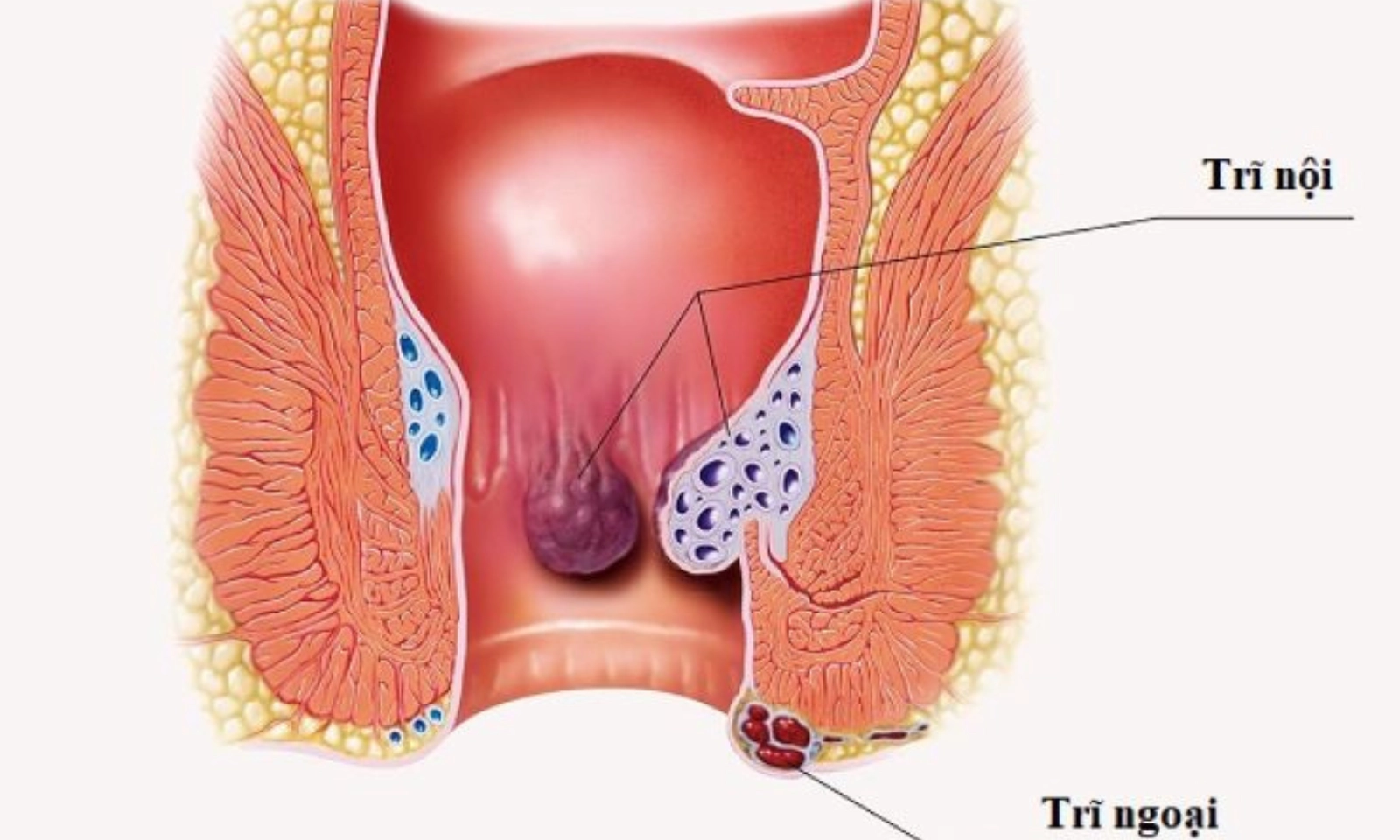 Bệnh trĩ - Đừng chủ quan khi bệnh ghé thăm