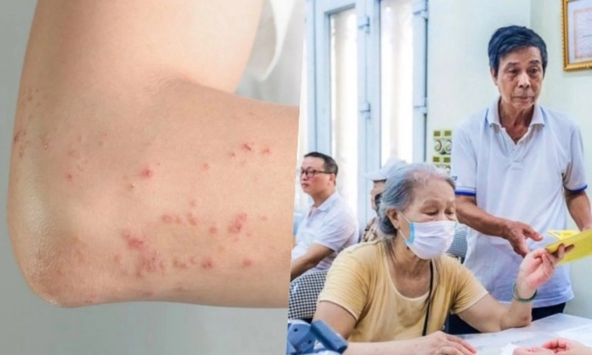 Điểm tin trưa 11/4: Sởi gây tử vong ở người lớn | Trợ cấp cho người từ 75 tuổi không lương hưu