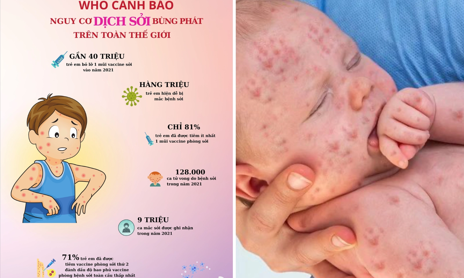 Sống chất: Cần chuẩn bị gì cho con yêu khi dịch Sởi đang báo động?