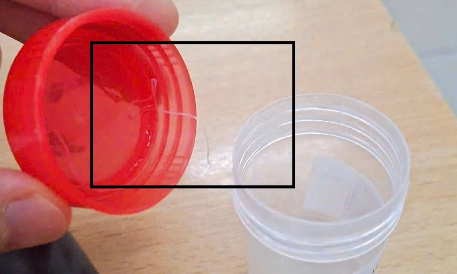Gắp ký sinh trùng dài gần 10 cm trong mắt người phụ nữ