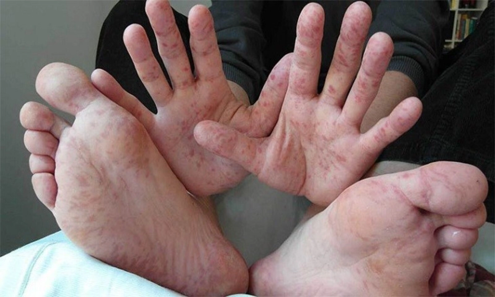 Những bộ phận trên cơ thể bị ngứa nên đi khám sớm, cẩn thận có thể là ung thư