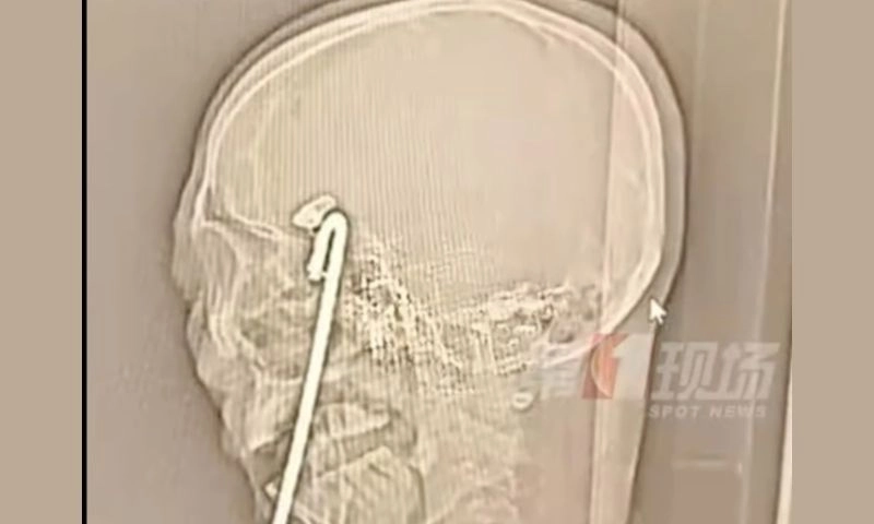 Ngã khi say rượu, người đàn ông bị thanh sắt đâm xuyên từ miệng vào não