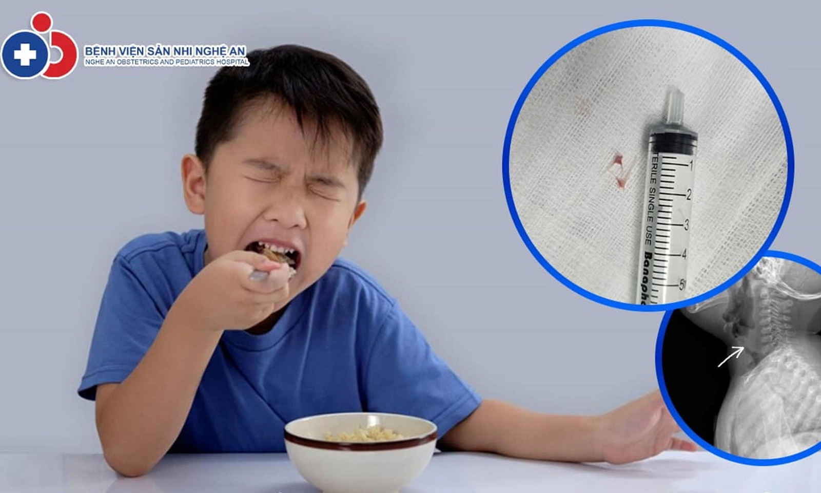 Hai mảnh xương cá mắc vào đường thở bé trai 16 tháng tuổi