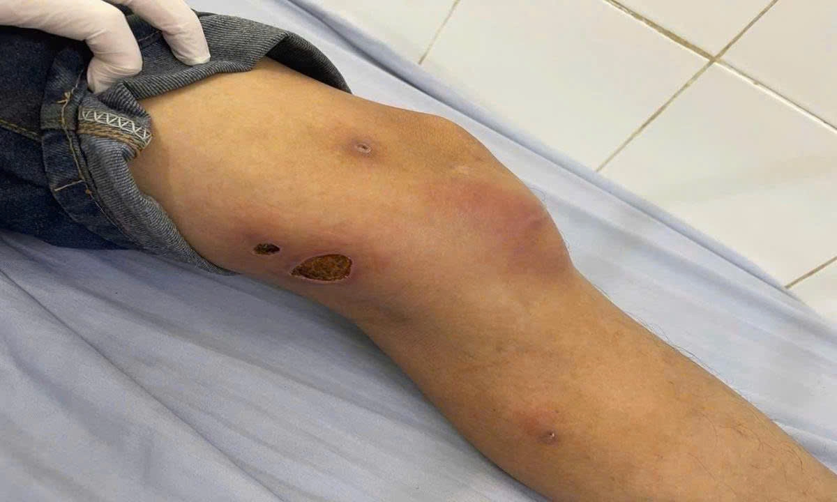 Cảnh báo bệnh giun rồng tái xuất tại Phú Thọ