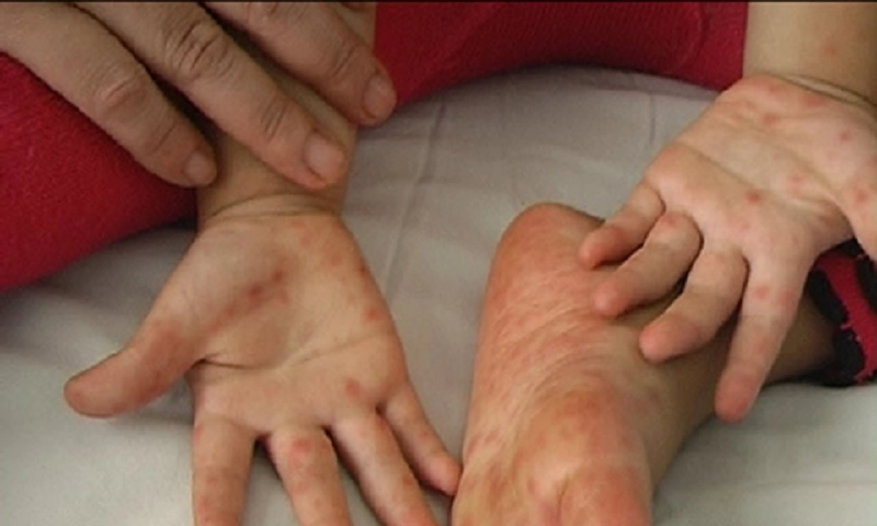 TPHCM: Số ca mắc tay chân miệng và sốt xuất huyết tăng