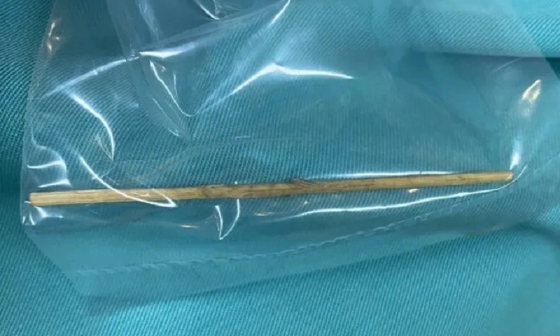 Bé trai 12 tuổi ở Bình Dương bị cây tăm đâm thủng tá tràng, phải mổ cấp cứu