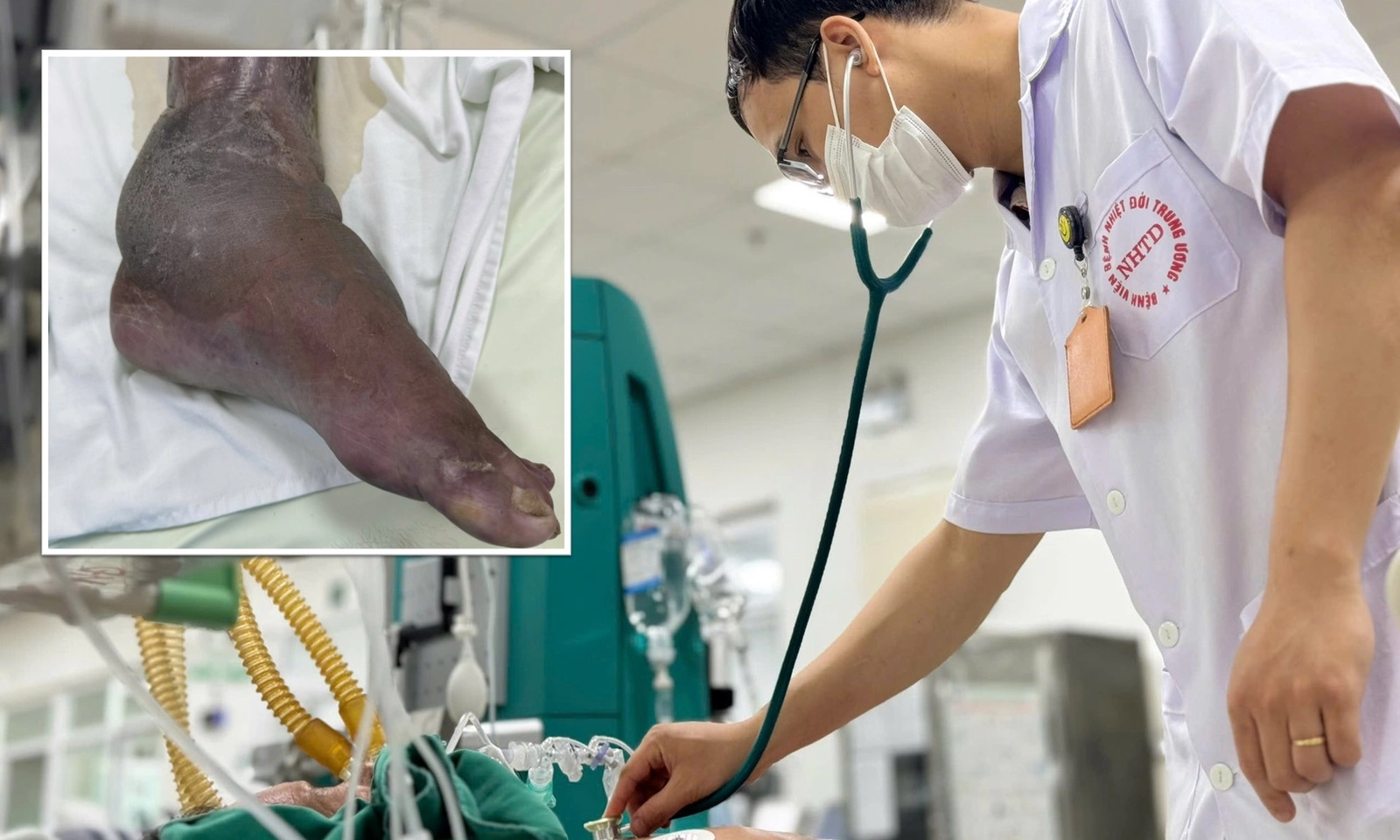 Bị gai đâm vào cẳng chân ở đầm tôm, người đàn ông rơi vào nguy kịch