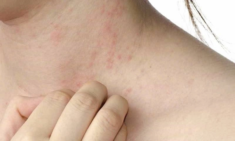 TPHCM cảnh báo nguy cơ dịch sởi: hơn 9.000 ca mắc, 7 người tử vong