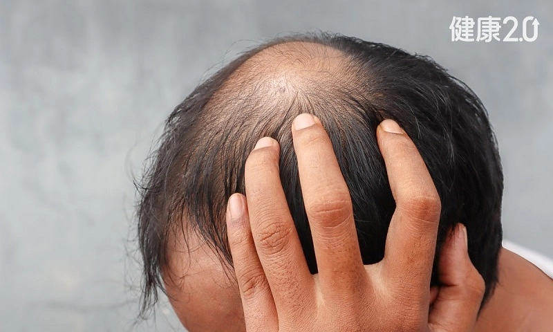 Uống nhiều đồ uống có đường làm tăng nguy cơ hói đầu lên gấp 3 lần!