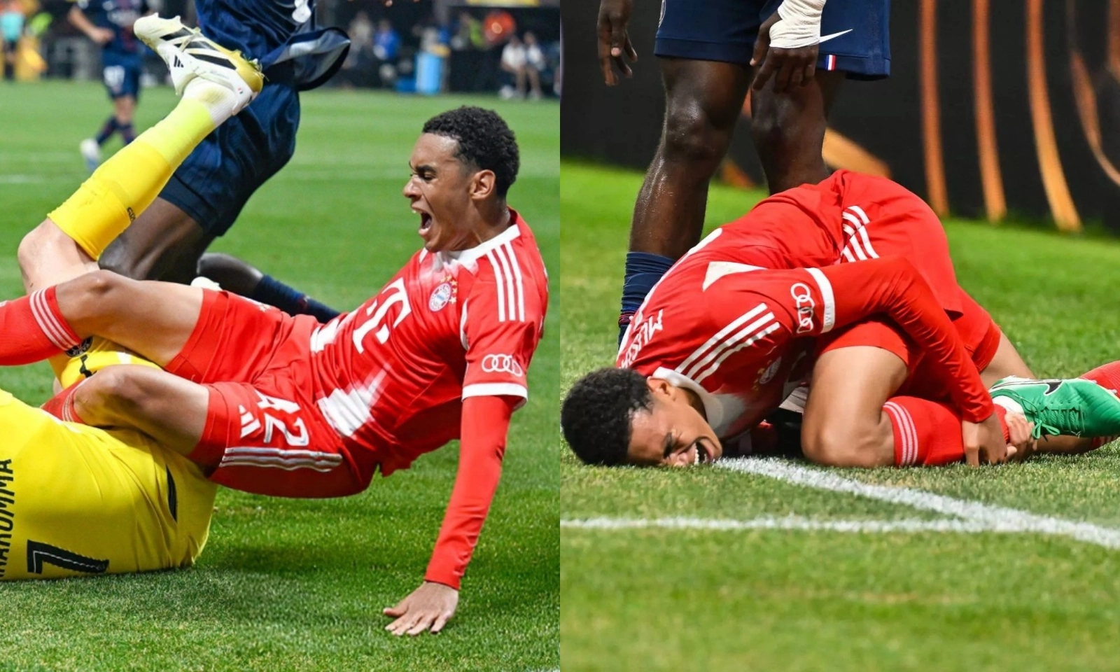 Cận cảnh chấn thương khủng khiếp của Musiala 