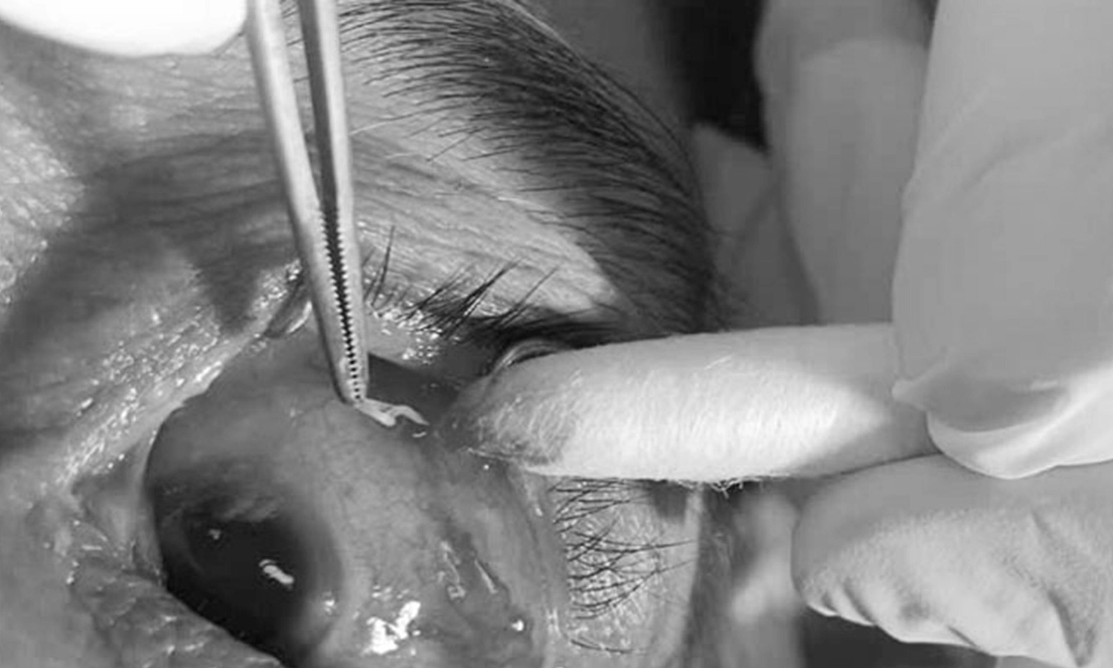 Bị viêm thượng củng mạc do giun sán ký sinh trong mắt