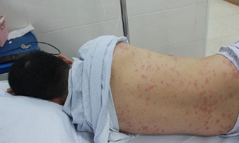 Hà Nội ghi nhận trường hợp thứ 6 mắc bệnh liên cầu lợn