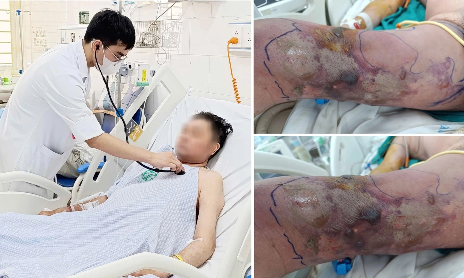Bị sinh vật lạ đốt khi tắm biển, người đàn ông nhiễm trùng hoại tử nguy kịch