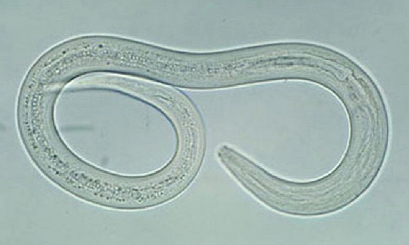 Cụ ông phù chân tay, sụt 11 kg vì nhiễm giun lươn