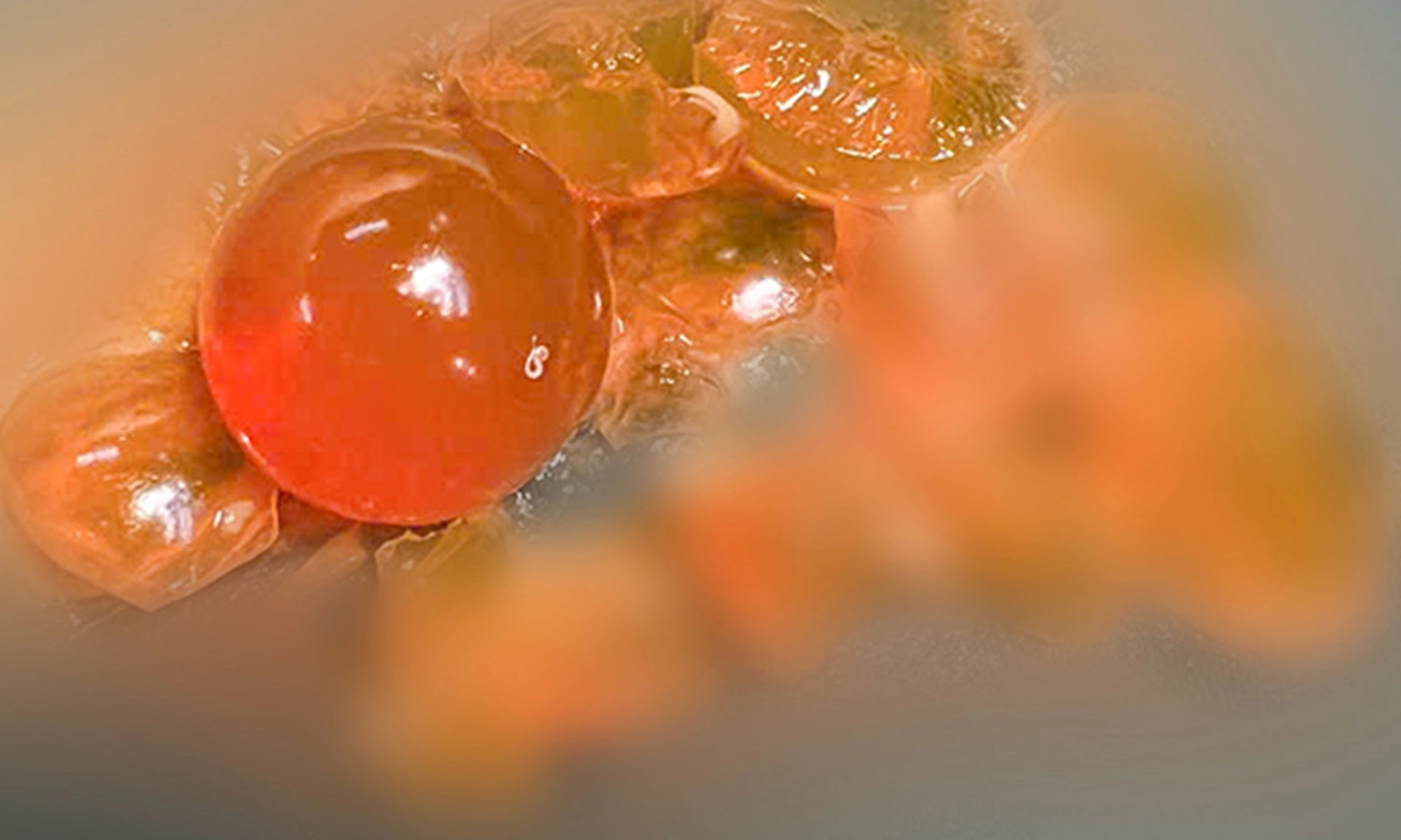 Cứu bé trai 14 tháng tuổi bị tắc ruột do nuốt nhiều hạt nở