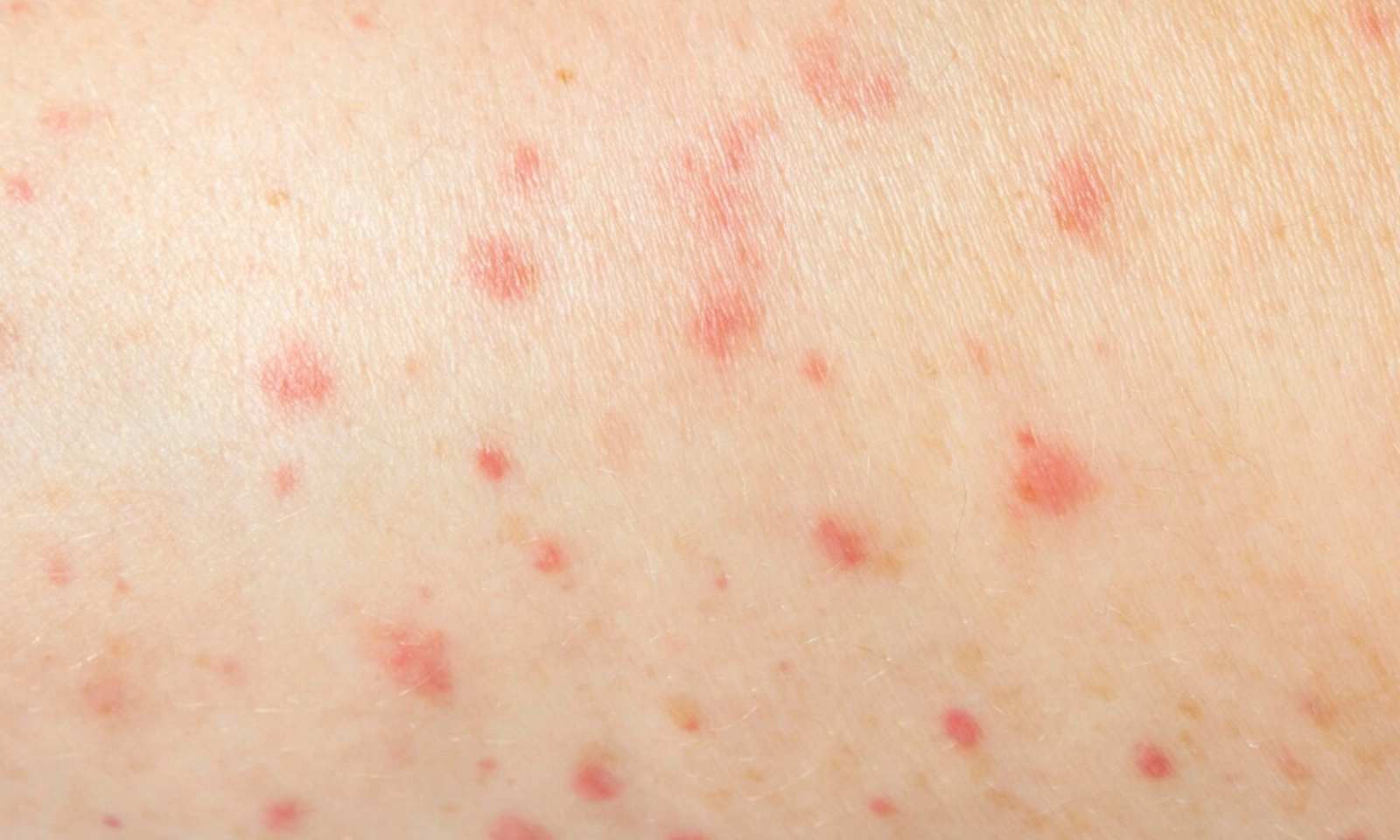 Tái phát bệnh zona nhiều lần làm tăng nguy cơ mắc chứng mất trí nhớ