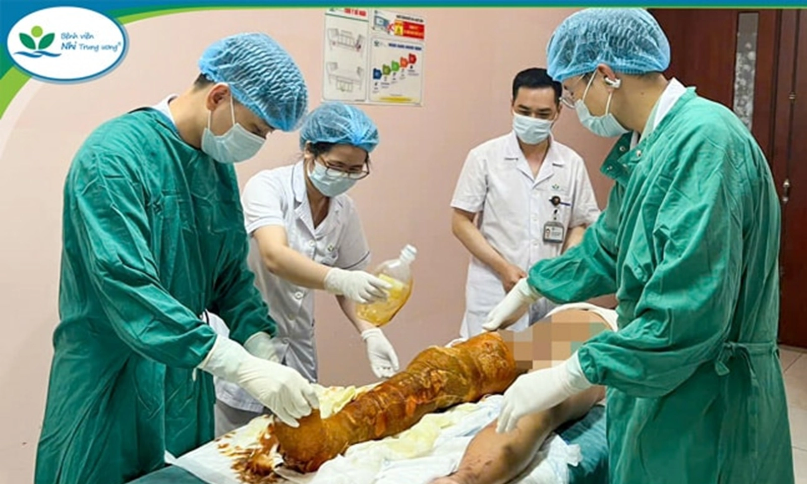 Bé trai bỏng nặng do tự lấy cồn làm thí nghiệm tại nhà