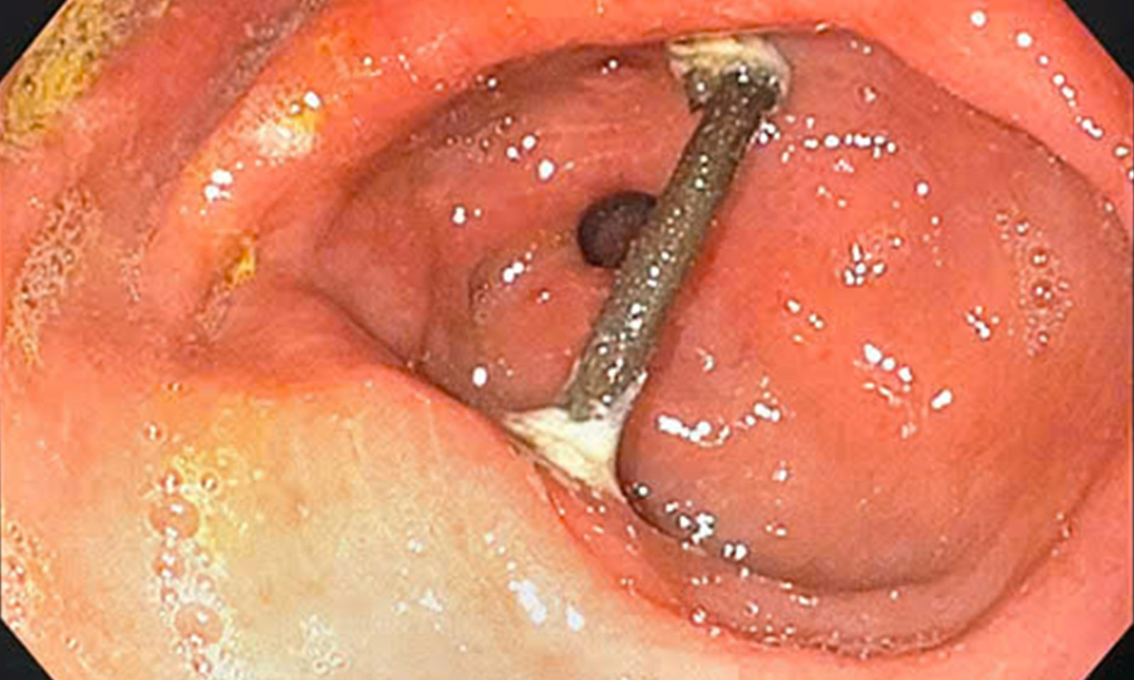 Uống thuốc lá tự sắc, người đàn ông nuốt phải cành cây dẫn tới thủng dạ dày