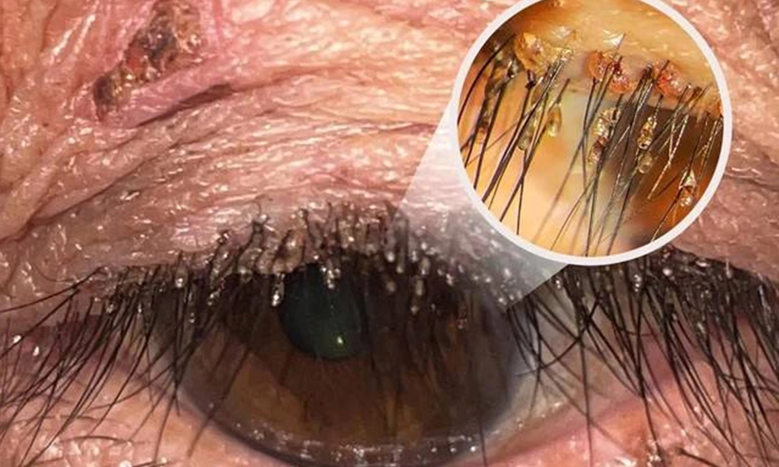 Ngứa mi mắt dai dẳng, bệnh nhân bất ngờ phát hiện bị rận mu “lạc chỗ”
