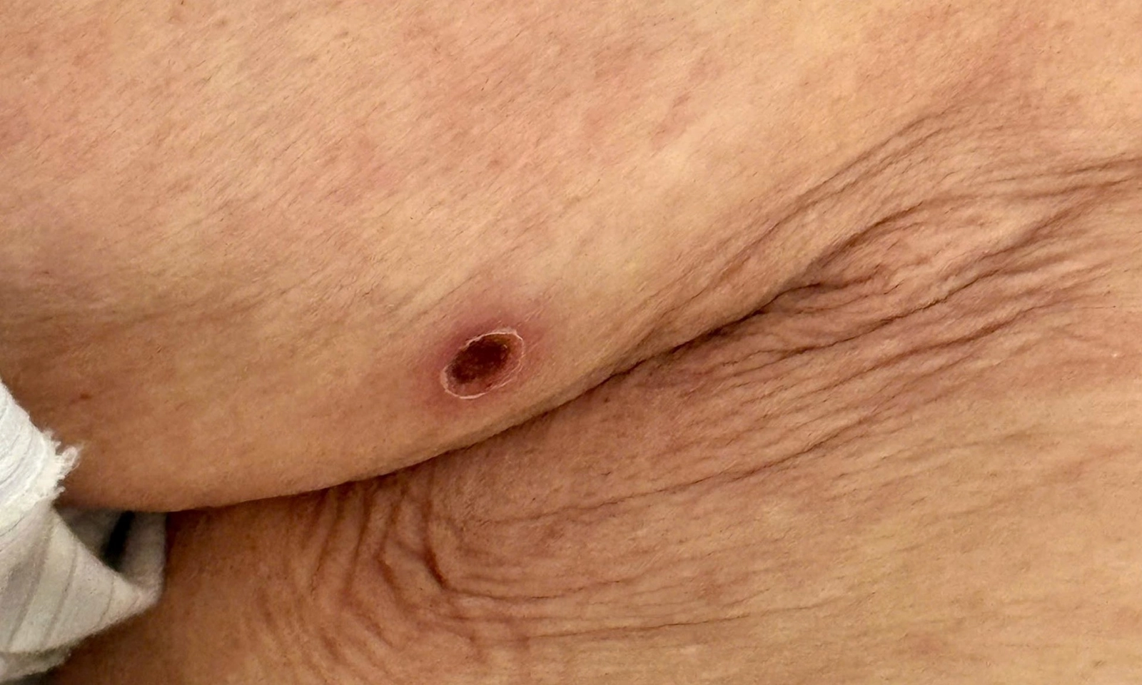 Cảnh giác với bệnh sốt mò