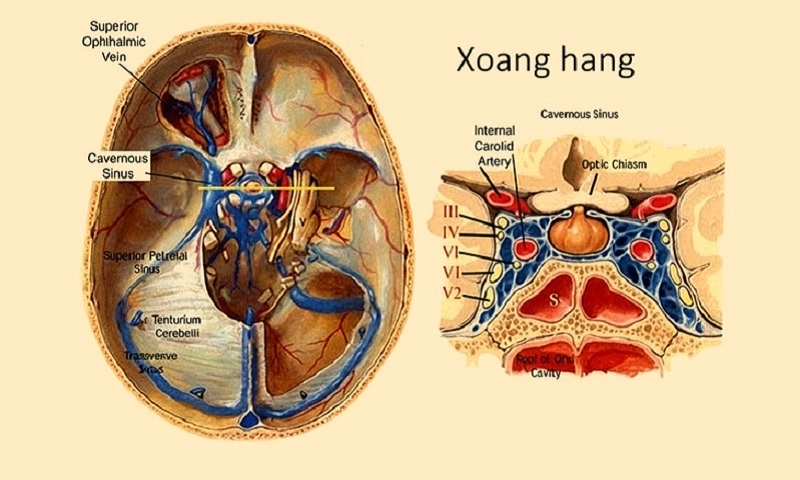 Nam thanh niên nhập viện nguy kịch do viêm tắc tĩnh mạch xoang hang