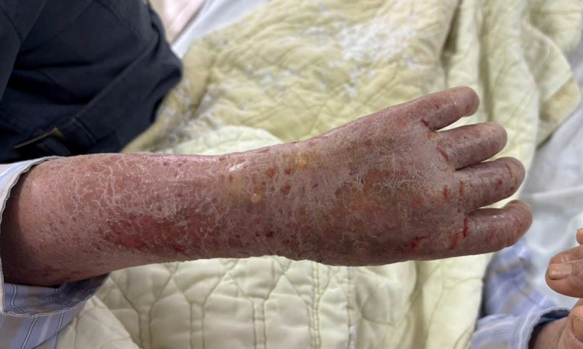 Đắp thuốc lá để chữa ngứa, cụ bà bong vảy khắp người