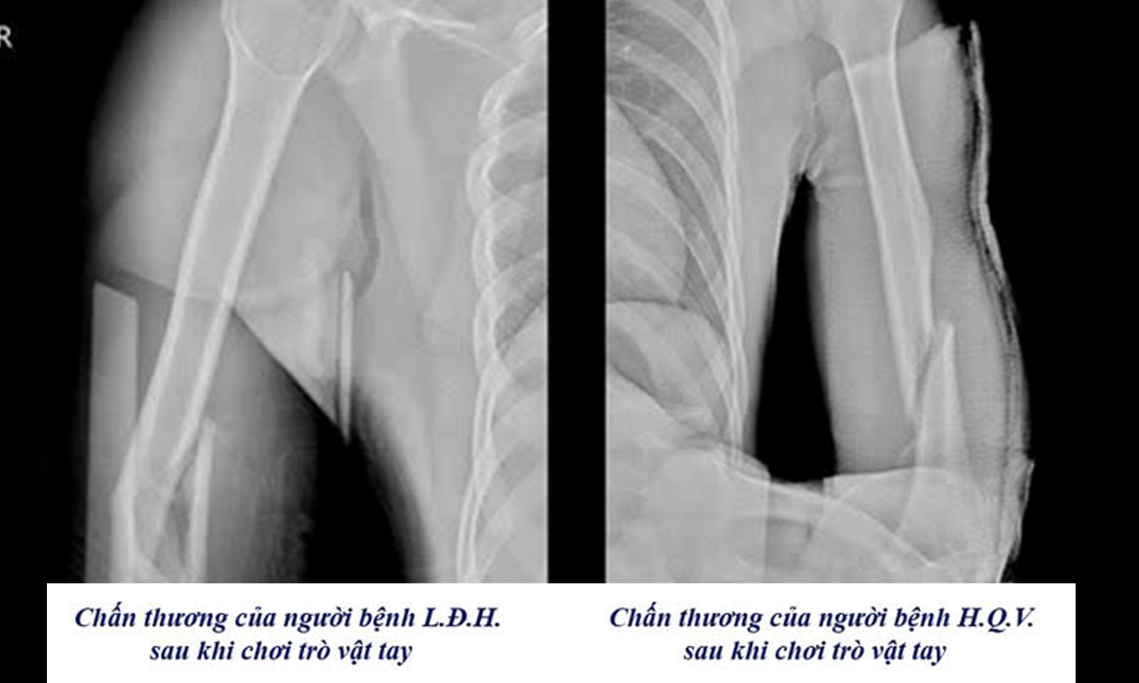 3 người gãy tay vì chơi “vật tay” trong vòng một tuần