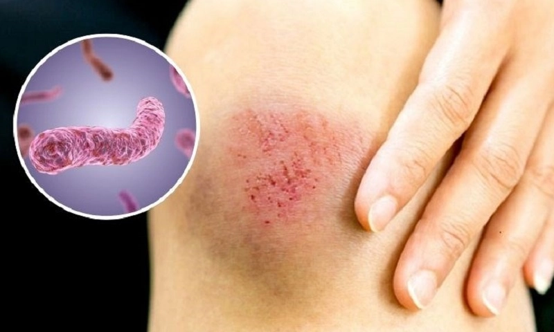 Thanh Hóa: Điều trị thành công thiếu niên mắc bệnh Whitmore biến chứng nặng