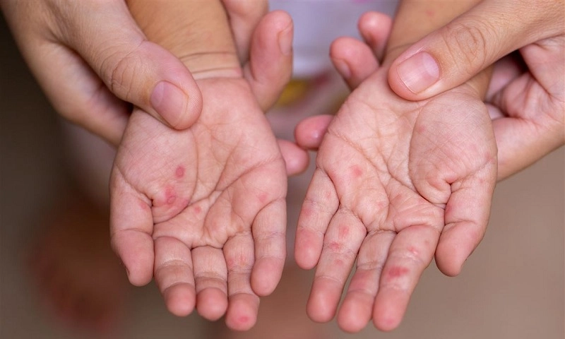 TPHCM cảnh báo số ca tay chân miệng nặng tăng