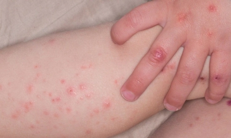 TPHCM cảnh báo EV71 gây tay chân miệng nặng