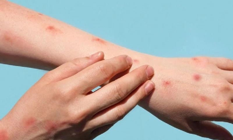 Đồng Nai ghi nhận ca đậu mùa khỉ, ngành y tế khẩn trương truy vết