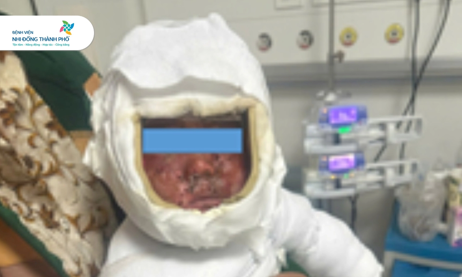 Bé trai 9 tháng tuổi bỏng 30% cơ thể do kéo dây nguồn ấm siêu tốc