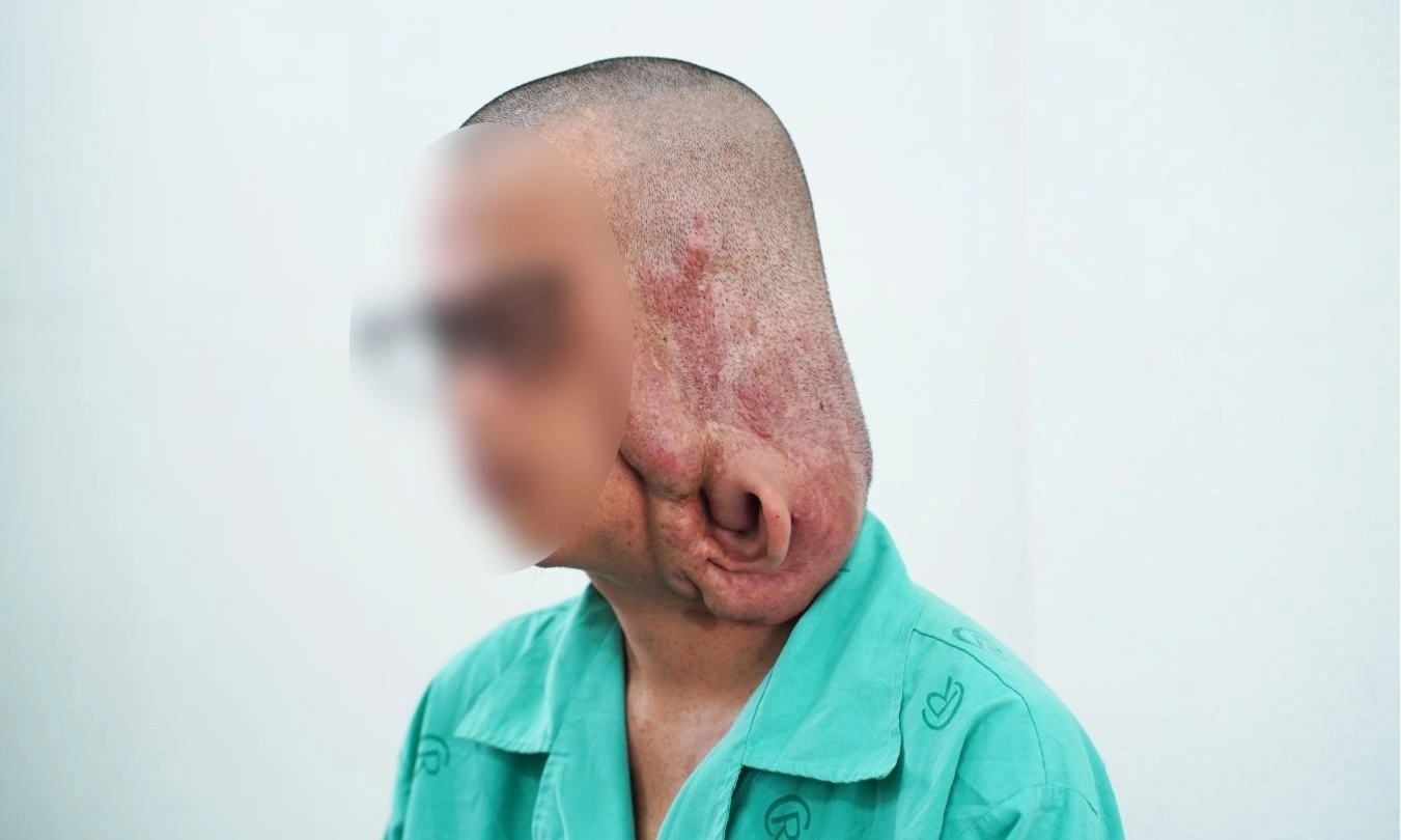 Bệnh viện Chợ Rẫy phẫu thuật thành công khối u sợi thần kinh nặng hiếm gặp