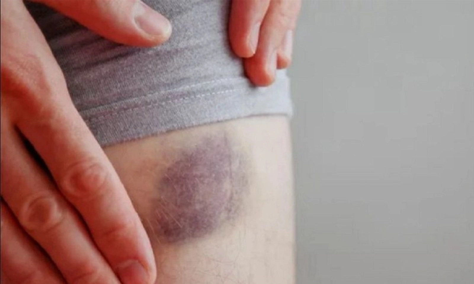 Những cách làm tan máu bầm hiệu quả tại nhà