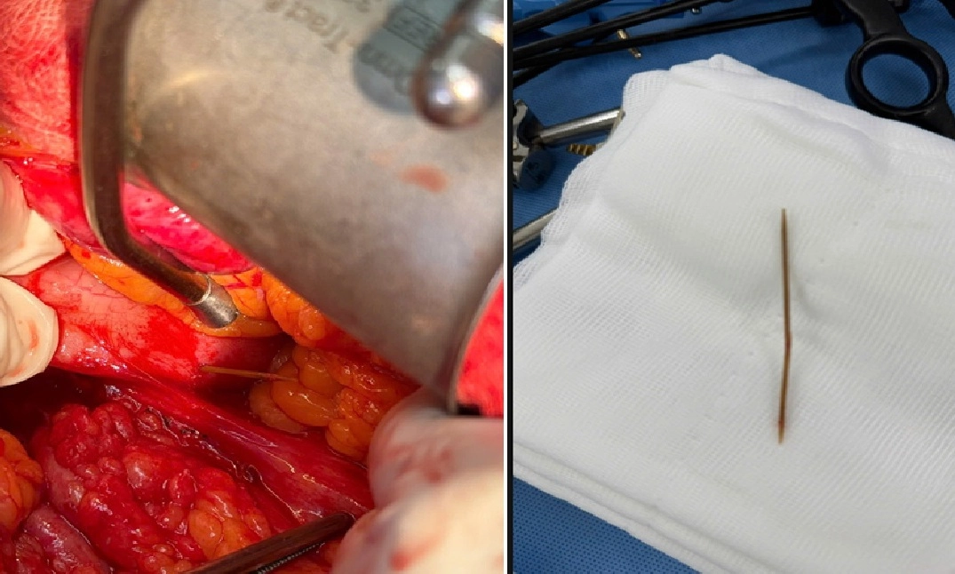 Hóc xương cá và thói quen ngậm tăm - Từ tai nạn sinh hoạt đến cấp cứu ngoại khoa