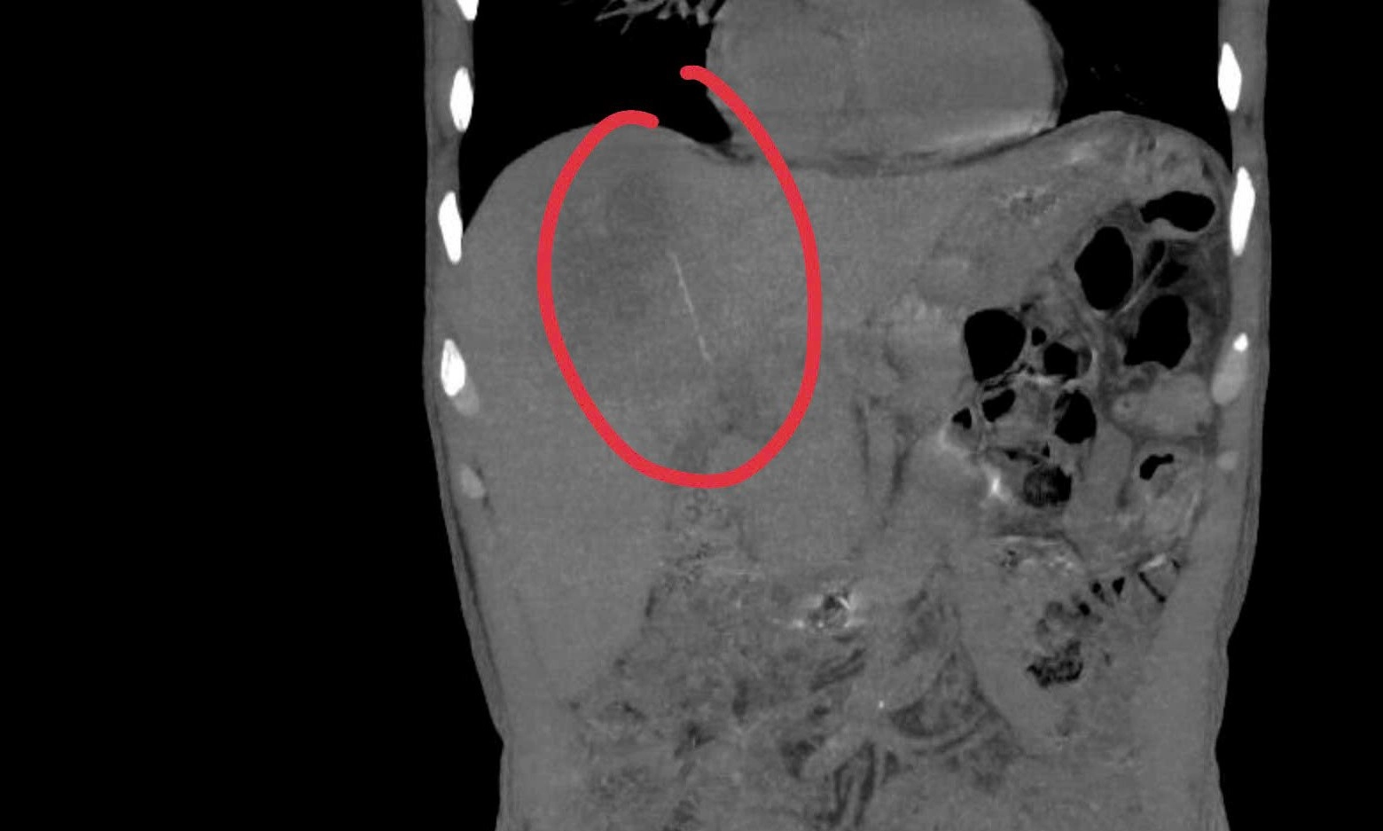 Từ thói quen thường ngày, dẫn đến đối mặt biến chứng nguy hiểm