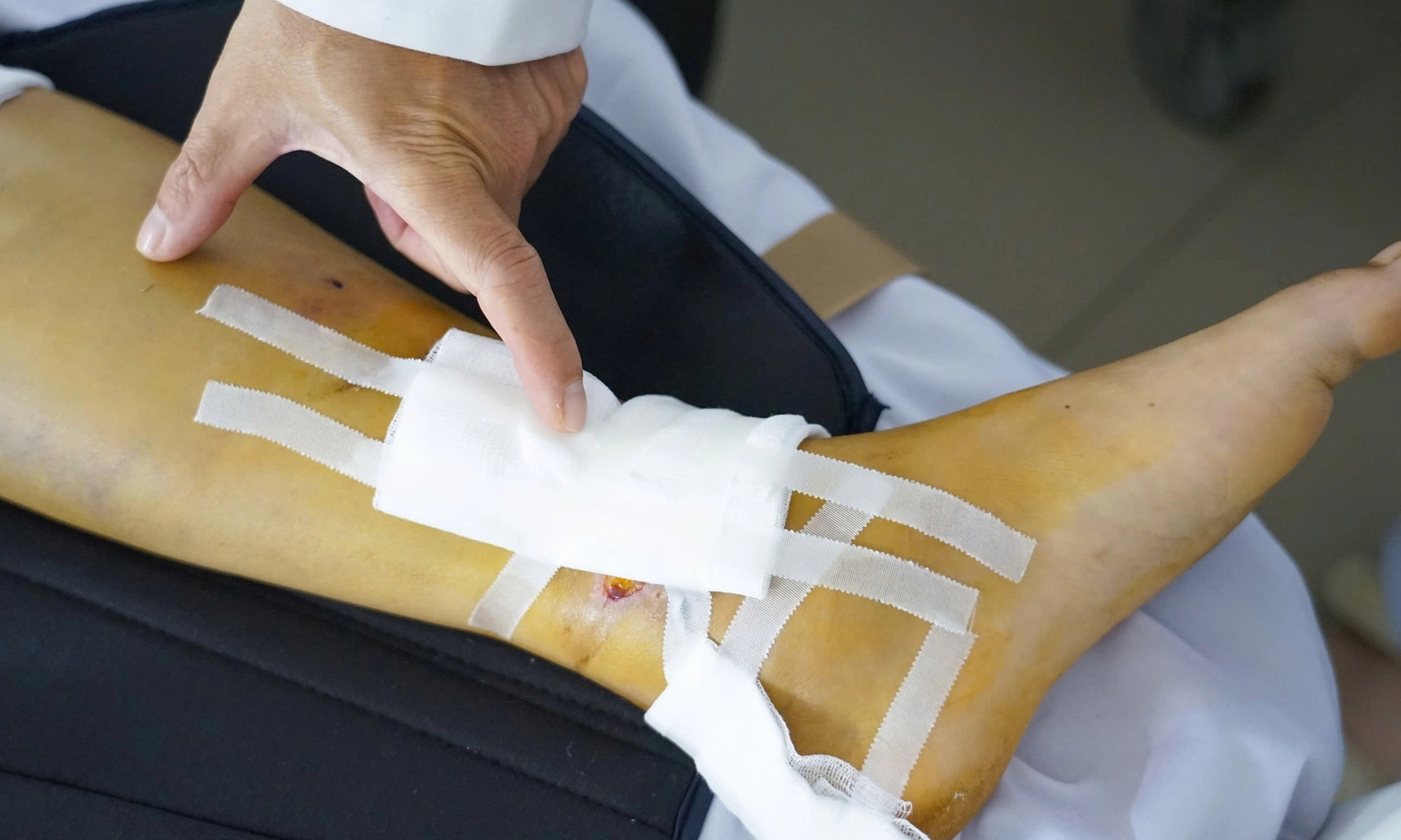 Phẫu thuật thành công ca đa chấn thương gãy ổ cối phức tạp