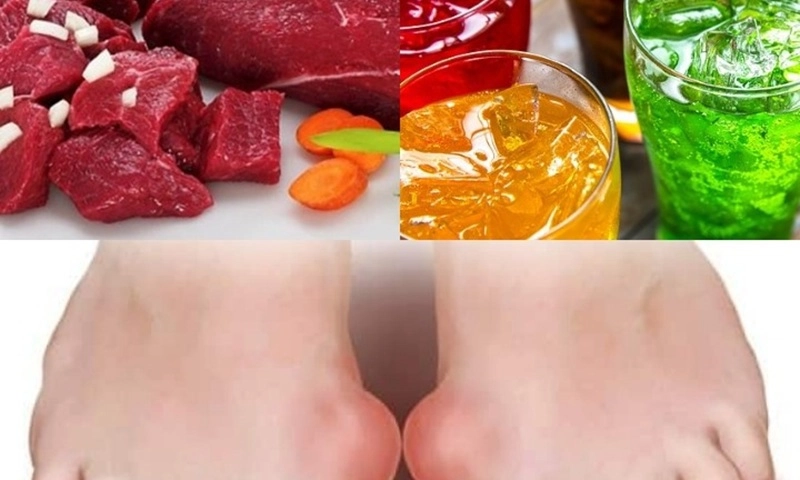 Sai lầm khi điều trị gout khiến bệnh ngày càng nặng
