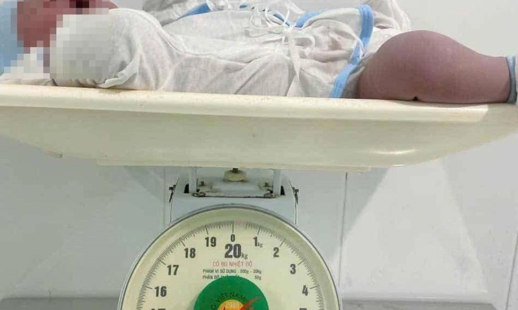 Hy hữu bé trai chào đời nặng 5,8kg