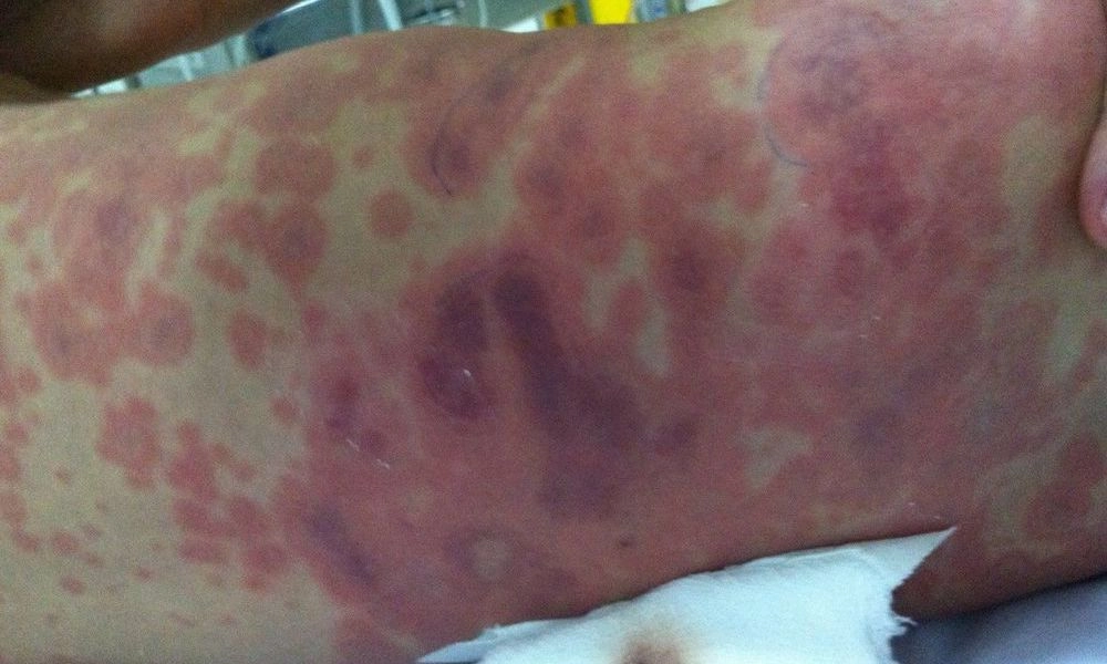 Cảnh báo nguy cơ lây lan viêm màng não mô cầu, yêu cầu giám sát chặt