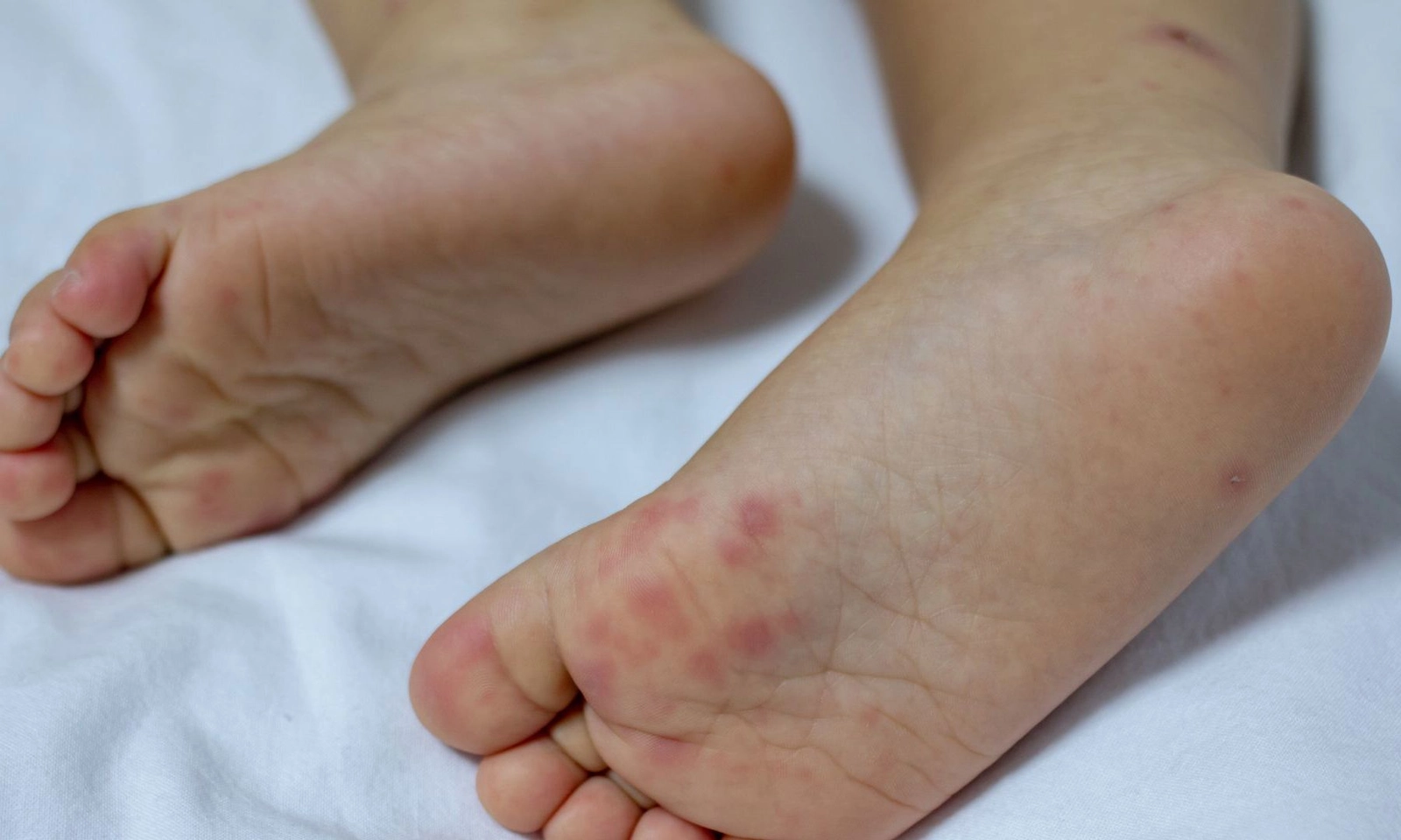 3 tháng, hơn 25.000 ca mắc tay chân miệng, tăng gấp 5 lần