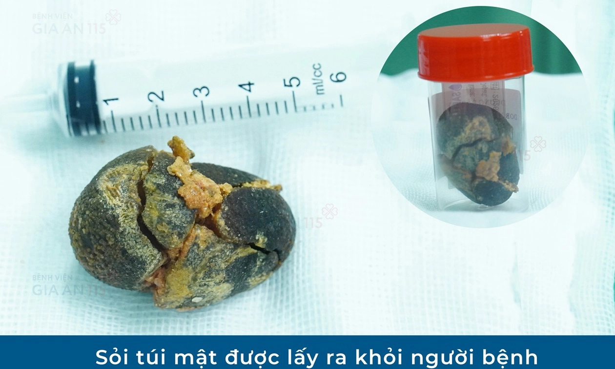 Phát hiện sỏi túi mật 5cm, cảnh báo nguy cơ âm thầm