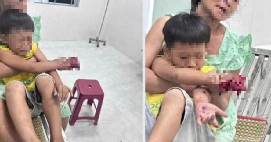 Điện thoại nổ lúc sạc pin, cháu bé 9 tuổi bị dập bàn tay phải